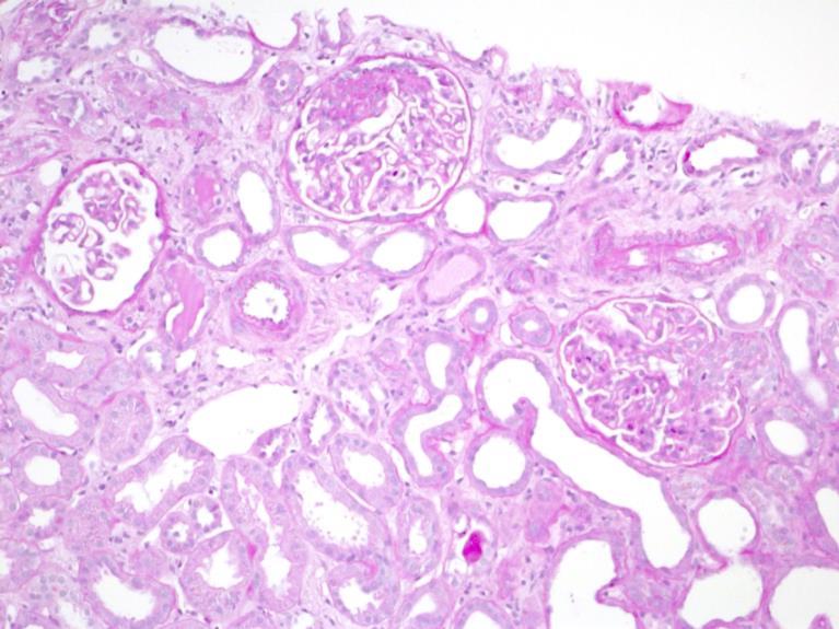 Nierenbiopsie Histologische Diagnose Teils rezente, teils narbig organisierte aterioläre und glomeruläre thrombotische