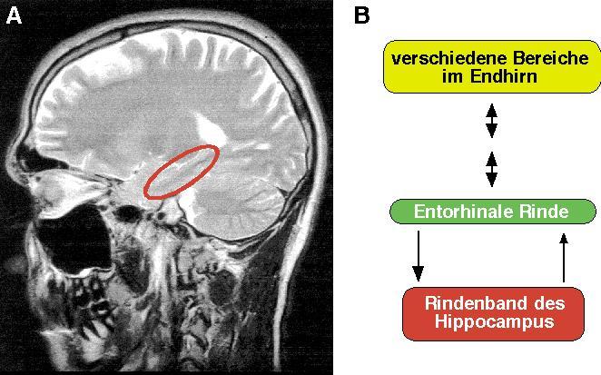 Alzheimer Erkrankung MRT (Brandt und Hanser, Gehirn