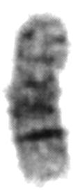 Abbildung 42 Fall 118/02: Partielles Karyogramm nach GTG-Bänderung: links normales Chromosom 8, rechts strukturell verändertes Chromosom 8. Das Ideogramm zeigt das Ausmaß der Duplikation.