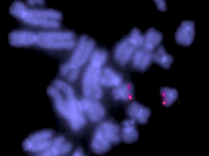 Zusammenfassung Es konnte keine Chromosomenaberration mittels CGH des zu untersuchenden Gewebes nachgewiesen werden. Molekularcytogenetisch gab es keinen Hinweis für eine Trisomie 21.