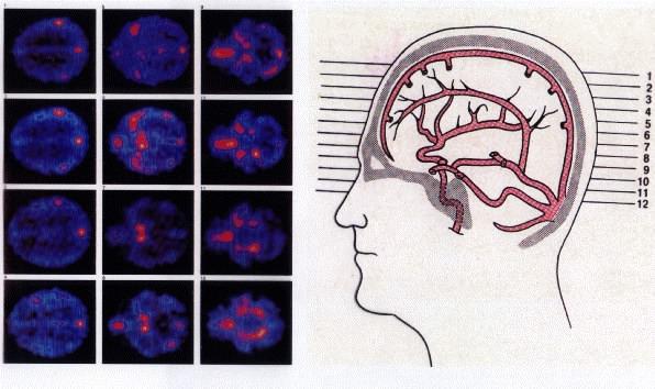 Abbildung 7.22: Durchblutungsmessung im Gehirn mit PET 7.3.