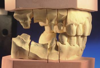 perfekt in den Patientenmund einfügt, dass er von natürlichen Zähnen nicht mehr zu unterscheiden ist.