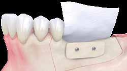 Ein Sicherheitsabstand von etwa 1 mm zu den benachbarten Zähnen ist einzuhalten.