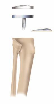 ABLAUF DER OPERATION Eine Operation, bei der eine Knieendoprothese implantiert wird, ist dischen Eingriffen, was sich anhand von unabhängigen nationalen mittlerweile ein gängiges und vorhersagbares