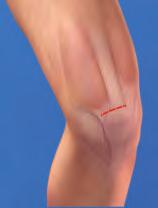 Wir bevorzugen die Lagerung des zu operierenden Beines am elektrischen Beinhalter und des gesunden Beines in Steinschnittposition.