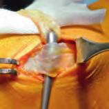 Der Knochen des Patella randes sollte mit Hilfe eines Luers angefrischt werden, um eine schnelle Anheilung zu gewährleisten