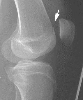 Abbildung 6: Zwei seitliche Röntgenaufnahmen zweier Kniegelenke. Linke Abbildung: Linkes Kniegelenk. Röntgenaufnahme mit übereinander projizierten posterioren Kondylen.