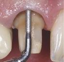 Bei minimaler Einstellung der Ultraschallstärke dient dieser Ansatz zum Polieren des Dentins. Ref.-Nr.