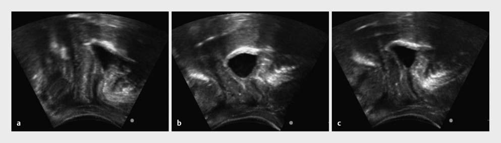 Abb. 3 Die perinealen Ultraschallbilder zeigen die typische Situation bei einer Frau mit deutlichem BH-Deszensus bei der Schulterbrücken-Übung in Ruhe, während und am Ende der Übung: a Ruhe, b