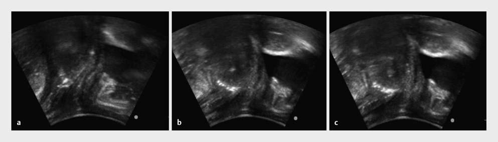 Abb. 4 Die perinealen Ultraschallbilder zeigen eine typische Situation bei einer Frau, die den BH gut stabilisieren konnte, bei der Schulterbrücken-Übung in Ruhe, mit BB-Präkontraktion und am Ende