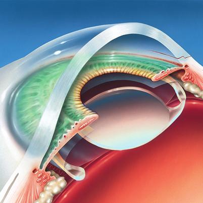 Mit Ultraschall wird die Linse zerkleinert und abgesaugt Die gefaltete Linse wird ins Auge implantiert Ansicht der entfalteten Linse im Auge Femtosekundenlaser-unterstützte Methode Seit wenigen