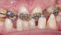 Basis ist das super-hochtransluzente polychrome Zirkonoxid Ceramill Zolid FX Multilayer, das den Zirkonoxiden der sogenannten dritten Generation angehört [1].