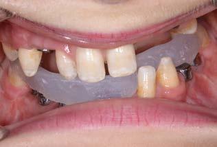 Im Oberkiefer sollten vier Implantate sowie sechs Zähne