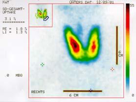 Aktive Aufnahme - Ionentransport Szintigraphie der Schilddrüse mit 99m TcO - 4 Aktive Aufnahme -