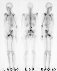 Passive Aufnahme Chemisorption Skelett-Szintigraphie Passive Aufnahme des