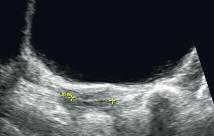 Abbildung 2: Uterus frühpubertär, B2-entsprechend, fehlender Endometriumsreflex. Lateral an der Blasenwand liegen beide Ovarien, klein, ohne follikuläre Aktivität.