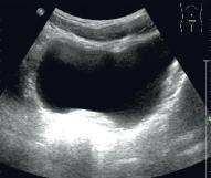 Weiterhin sind keine Ovarien nachweisbar. nografischen Entwicklung. Nach 18 Monaten Hormonersatztherapie ist ein gutes Ansprechen des Uterus erreicht (Abbildung 4).