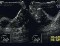 Abbildung 5: Uterus reif, breit aufgebautes Endometrium. Ovarien beidseits mit PCO-Bild (multiple kleine, randständige Follikel, erhöhtes Ovarvolumen) (9).