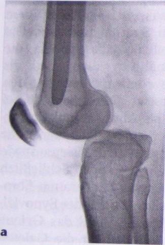 Kniegelenkluxation Hüftgelenkluxation Bei heftigem Trauma ( dashboard -Verletzung) Häufiger bei Z.n. Hüft-TEP