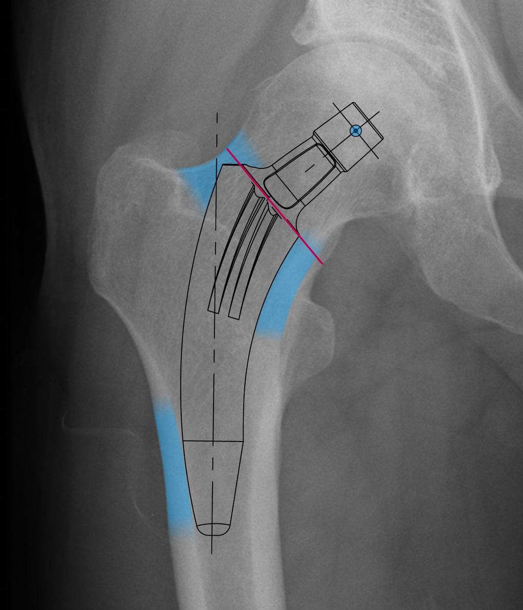 Bei Verwendung des M/L-Röntgenbildes sollte proximaler Kontakt posterior und anterior erzielt werden; distaler Kontakt wiederum posterior.