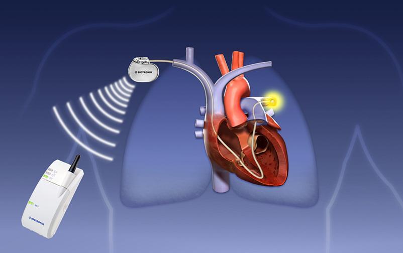 COMPASS Cardiac Output Monitor mit pulmonalarteriellen Sensoren Implantat (CPU,