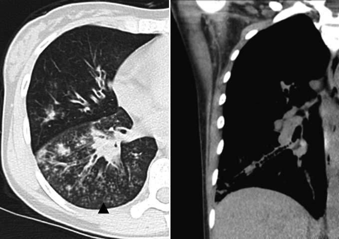 33 Abb.6 Sekundäre mit zentrilobulären Noduli und Tree-in-Bud-Zeichen (Pfeilspitze) bei pulmonalen Bronchiektasen im rechten dorsalen Unterlappen bei einer 44-jährigen Patientin. Abb.7 Sekundäre mit Mosaik-Muster bei einer 51-jährigen Patientin mit systemisch-progressiver Sklerose.