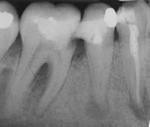 ZAHNMEDIZIN Nach Abschluss der konservierenden Therapie an Zahn 46 wurde der Zahn unter Kofferdam trepaniert, die Wurzelkanäle nach vorheriger elektrometrischer Längenbestimmung (VDW Gold, VDW )