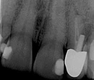 Hauptsächlich sind neben der oben beschriebenen endodontischen Inspektion der anatomischen Situation sicherlich die intrakanaläre Diagnostik (z. B.