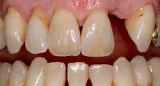 ZAHNMEDIZIN Fall 1: Ersatz des Zahnes 22 durch eine an Zahn 23 befestigte einflügelige Adhäsivbrücke Bei der 64-jährigen Patientin musste vor einigen Monaten der Zahn 22 aus parodontologischen