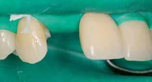 Dies wäre jedoch bei einer Implantatkrone etwas gewagt; eine Verblockung mit dem wurzelkanalbehandelten Zahn 21 erschien aufgrund der dann entstehenden Hybridsituation ebenso wenig als geeignet.