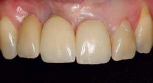 19: An Zahn 13 wurde der Kofferdam mithilfe von Zahnseide in den Sulkus ligiert. Abb.