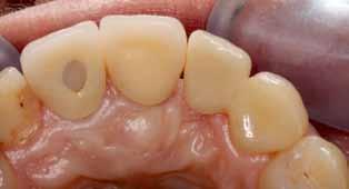Fall 3: Ersatz des Zahnes 12, distal an Zahn 13 Der folgende Fall der 17-jährigen Patientin erwies sich als eine kleine Herausforderung hinsichtlich der Zahnnomenklatur: Bei der Patientin war der