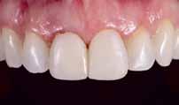 Durchleuchten der Zähne, um Composite- Reste zu identifizieren. Abb. 4: Zwei-Faden-Technik für die Abformung. Der Retraktionsfaden verbleibt im Sulkus.
