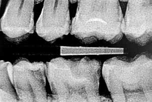 DENTALFORUM Komposit-Restauration: zweistufig zu Hochglanz Zahnärzte vereint bei der Politur von Kompositen der gleiche Wunsch: schnell und effizient Hochglanz zu erreichen.