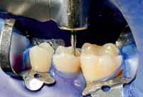 Dr. Alexander Fumig, favorisiert ein 2-stufiges Komposit-Poliersystem von Komet Dental. Herr Dr.
