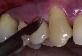 In diesem speziellen Fall liegt ein schmaler, überwiegend 3-wandiger Defekt an der distalen Zahnfläche von Zahn 14 vor.