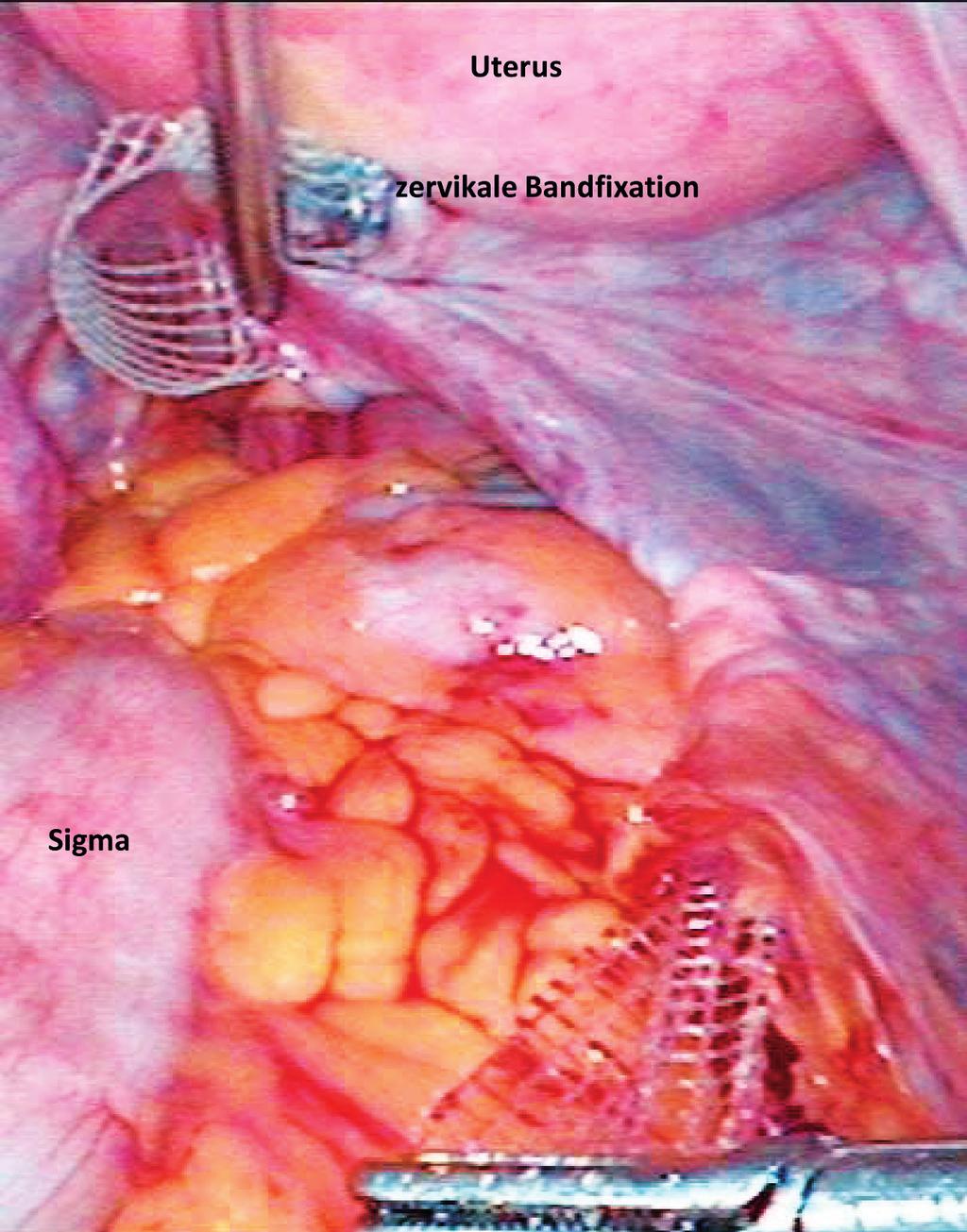 Das Verfahren der paravaginalen Defektkorrektur ist vaginal, abdominal und vor allem laparoskopisch durchführbar.