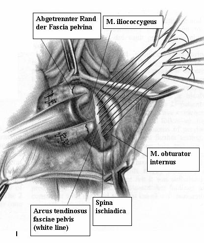 Abb. 19: Die Obturatoriusfaszie und der Arcus tendinosus werden eingestellt und mit ca. 5 nicht resorbierbaren Fäden, z. B.