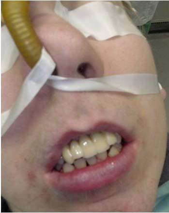 Frontzahnbereich Prothetische Versorgung eines Patienten nach Verlust des festsitzenden Zahnersatzes Nach notwendiger