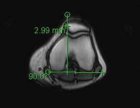 19 Abb. 14. Lateral Patellar Displacement (LPD): Maß für die laterale oder mediale Seitwärtsbewegung der Patella während der Kniestreckung.