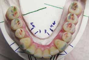 Nun wurde das Zirkonoxid-Gerüst im Bereich des Zahnfleischanteils mit Zirconia-Bond