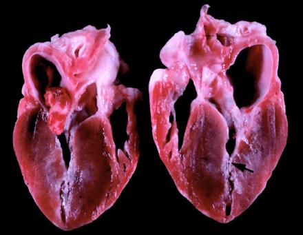 LITERATURÜBERSICHT 15 rechte als auch die linke Herzkammer hypertrophieren. Das Septum ist häufiger verdickt als die linke Wand (TILLEY et al., 1977).