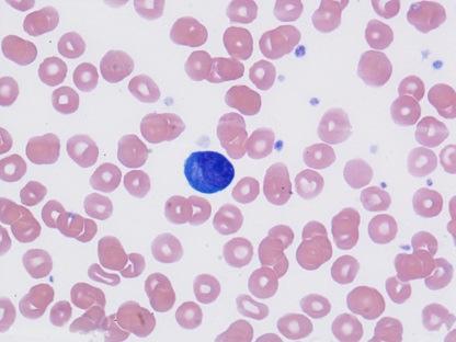 lymphoplasmozytisches Lymphom: hierzu haben womöglich die Plasmazellen, die im Blut meist nicht so