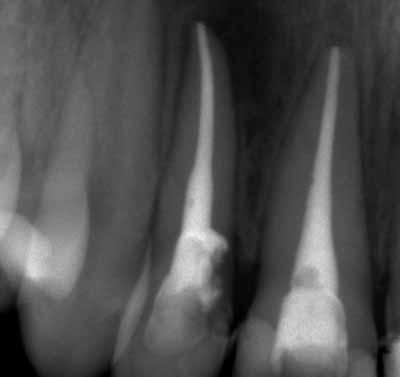 9: Die Aufnahme zeigt den Fall drei Monate nach Chirurgie: Deutlich sichtbarer PA-Spalt an Zahn und vollständige Mineralisation an Zahn 11.