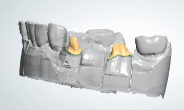 Präparation Nach der Präparation der Zähne 15, 16, 34 und 36 wurde eine konventionelle Abformung durchgeführt.