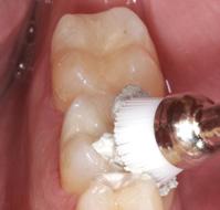 Polieren der beschliffenen Oberflächen ist für den Zahnarzt mit CELTRA schnell