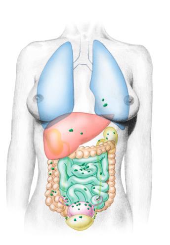 Lunge Leber Magen Dick- und Dünndarm (3) Gebärmutter Eierstock Eileiter (2) Harnblase (1) und -leiter Nieren Abbildung 1 Verschiedene Lokalisationen im Körper - http://www.eva-info.