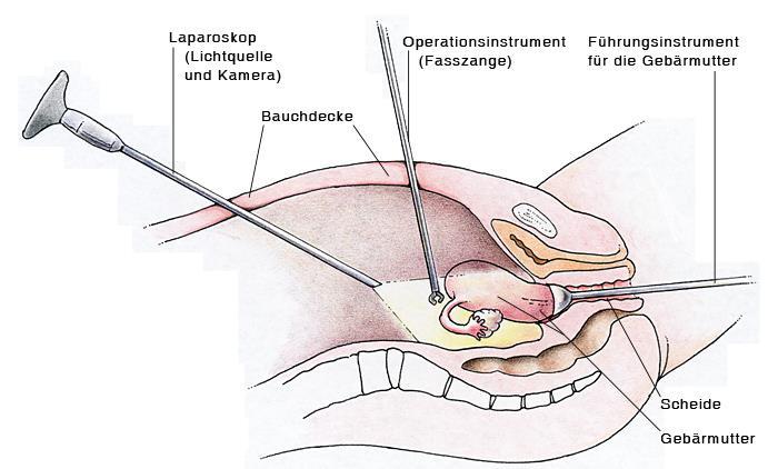 11.2 Chirurgische Therapie Der chirurgischen Entfernung der Endometrioseherde kommt große Bedeutung zu.