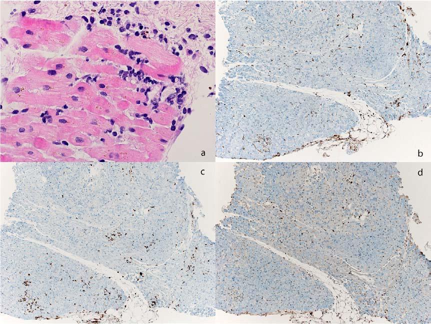 irae: Herz Figure 3 Histological analysis of endomyocardial biopsy. (a) Hematoxylin and eosin staining of the myocardial biopsy with focal mononuclear infiltrates.