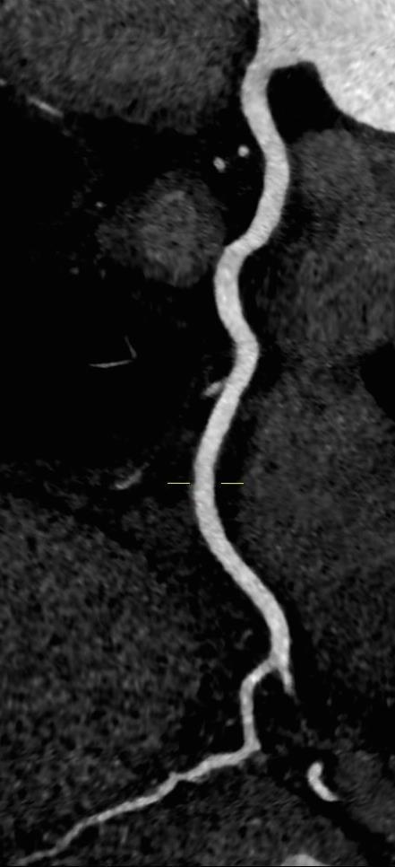 Abbildung 2: Automatische Darstellung eines unaufälligen rechten Herzkranzgefäßes in einer 0,5 mm dicken gecurvten CT-Schicht vom Abgang aus der